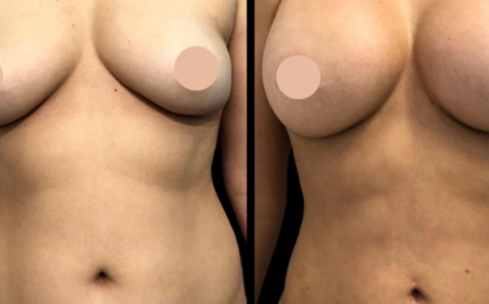 Breast Augmentation Surgery in Dubai: A Premium Cosmetic Experience