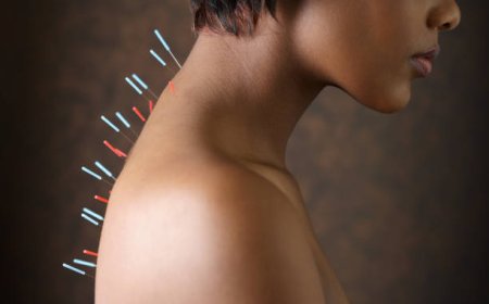 What to Expect from Acupuncture in Dubai?