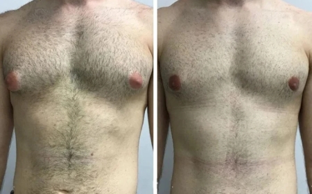Gynecomastia in Dubai: How to Prepare for Your Consultation