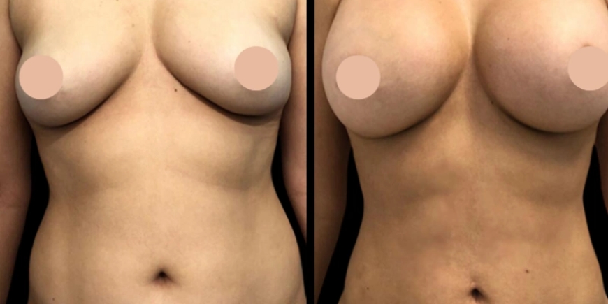 Breast Augmentation Surgery in Dubai: A Premium Cosmetic Experience