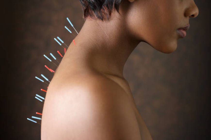 What to Expect from Acupuncture in Dubai?