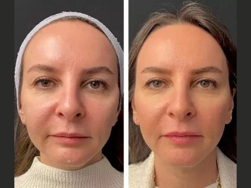 Mesotherapy in Dubai vs. Dermal Fillers: Which is Right for You?