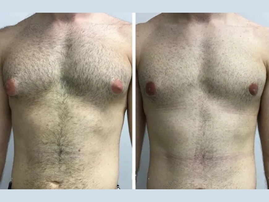 Patient Testimonials on Gynecomastia in Dubai