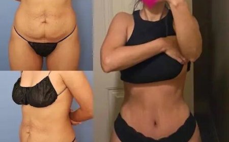 Best Doctors in Dubai for Tummy Tuck: What You Should Know Before Surgery