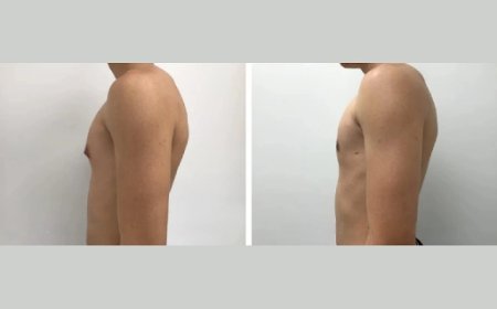 Why Choose Dubai for Gynecomastia Surgery?