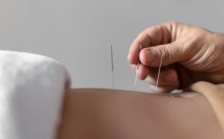 Integrating Dry Needling and Chinese Medicine: A Holistic Approach to Healing