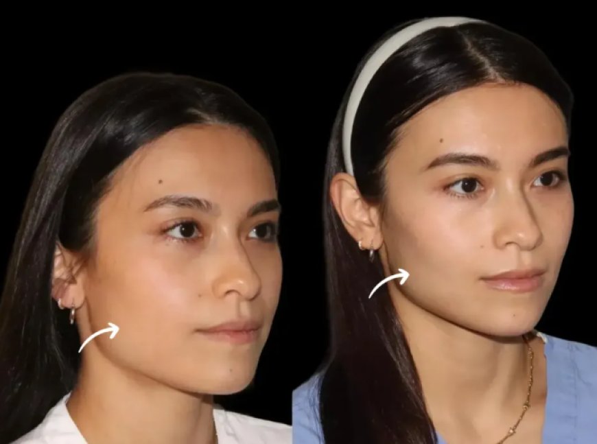 Eco-Friendly Practices in Sculptra Fillers at Dubai’s Best Aesthetic Clinic