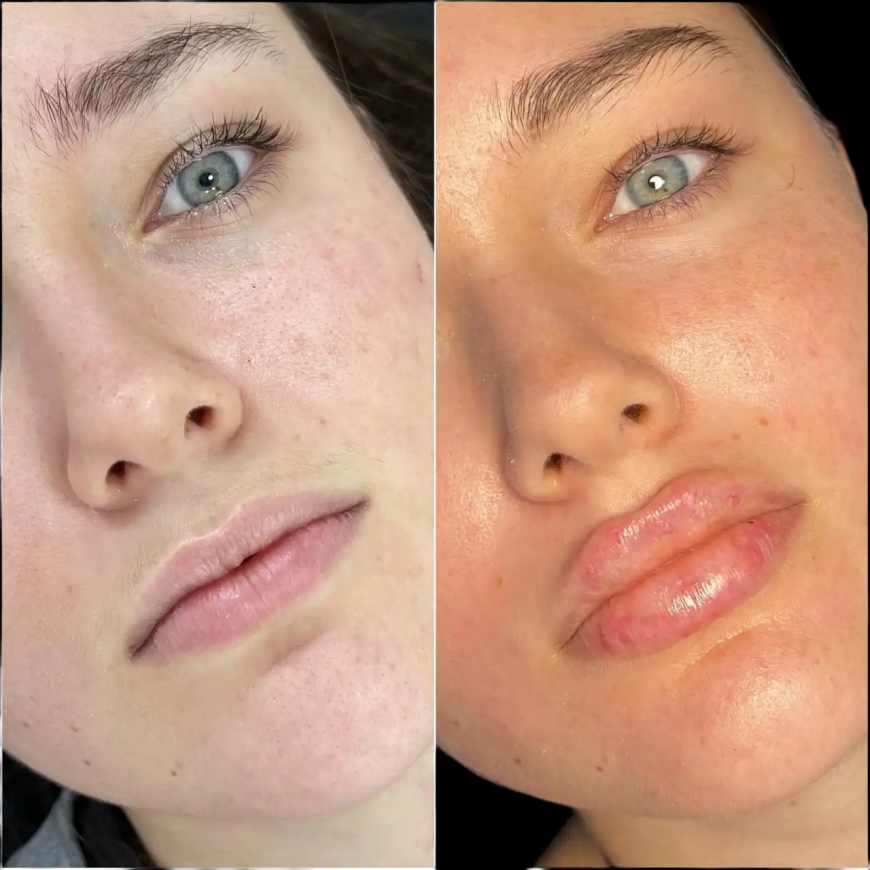 Fillers in Dubai That Deliver Real Results