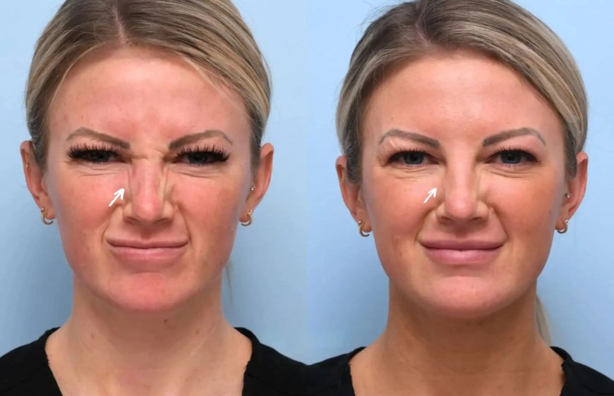 Is Botox Right for You Consult the Best Plastic Surgeon in Dubai for Tailored Advice