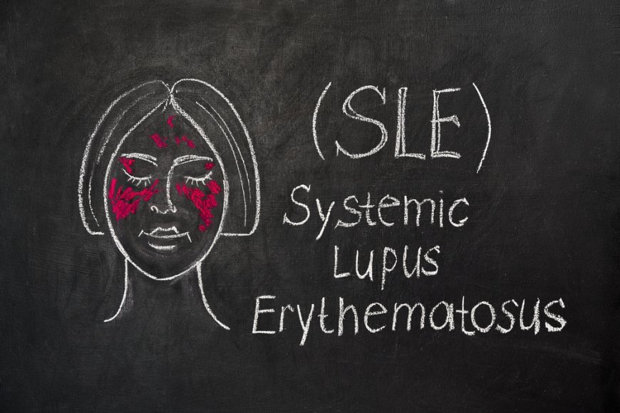 Systemic Lupus Erythematosus: A Comprehensive Overview