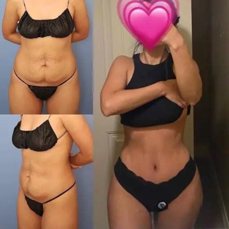 Best Doctors in Dubai for Tummy Tuck: What You Should Know Before Surgery