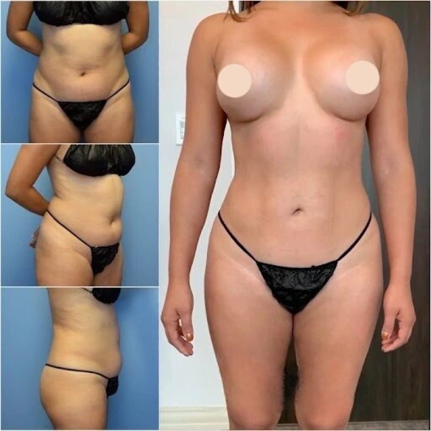 Discover Best Doctors in Dubai for Body Contouring and Sculpt Your Ideal Shape