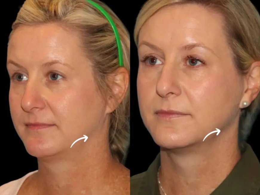 How AR visualization enhances Sculptra fillers planning in Best Aesthetic Clinics in Dubai