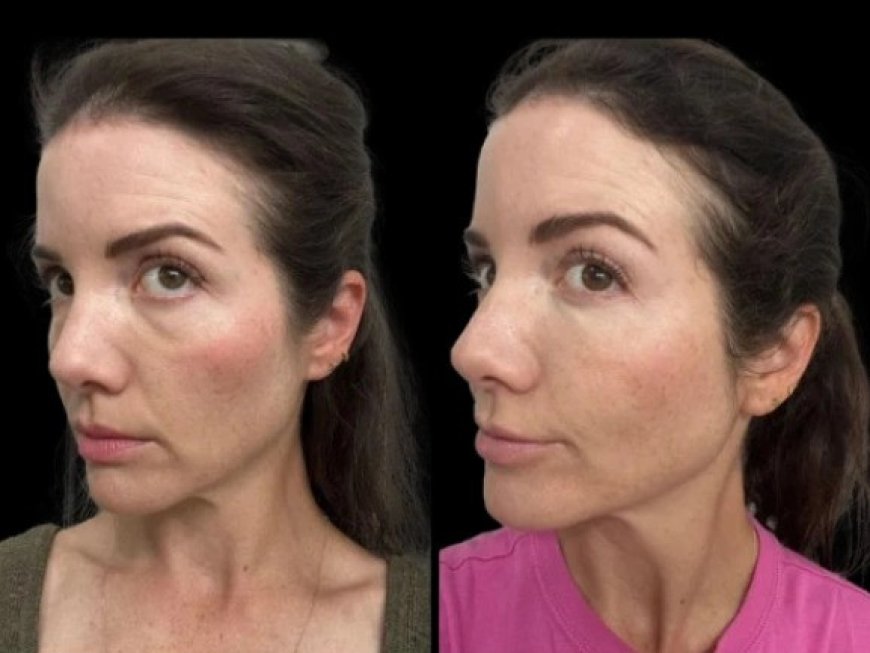 Dermatologist-Approved Dark Circles Treatments at the Best Aesthetic Clinics in Dubai