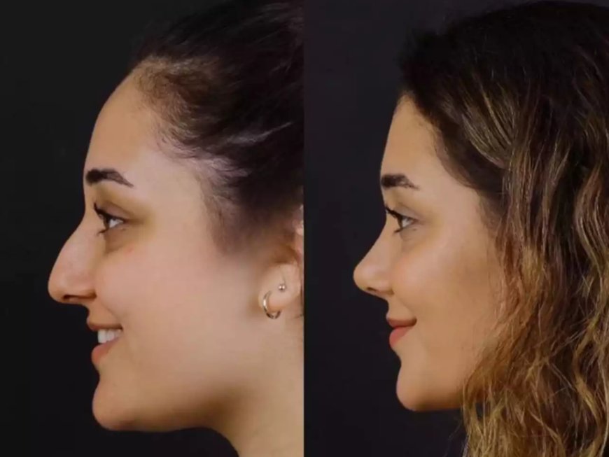 Is Recovery from Nose Deviated Septum Surgery in Dubai Easy?