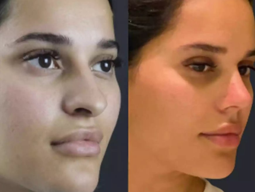 Before and After: Nose Surgery in Dubai Results